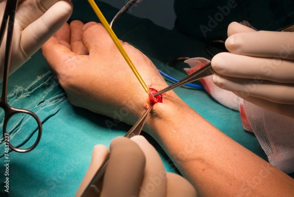 Obraz prepare cephalic vein for arteriovenous fistula