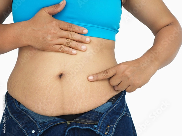 Obraz Asian woman show off displaying stretch marks on her abdomen after pregnancy caused by tearing of the dermis layer of the skin. Closeup photo, blurred.