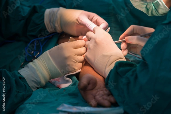 Obraz surgery team operate arteriovenous fistula