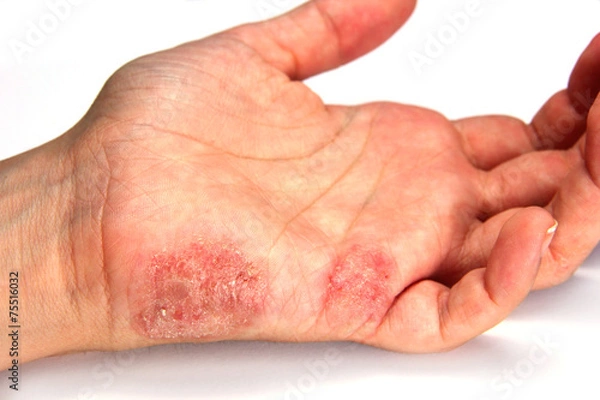 Obraz Skin Disease