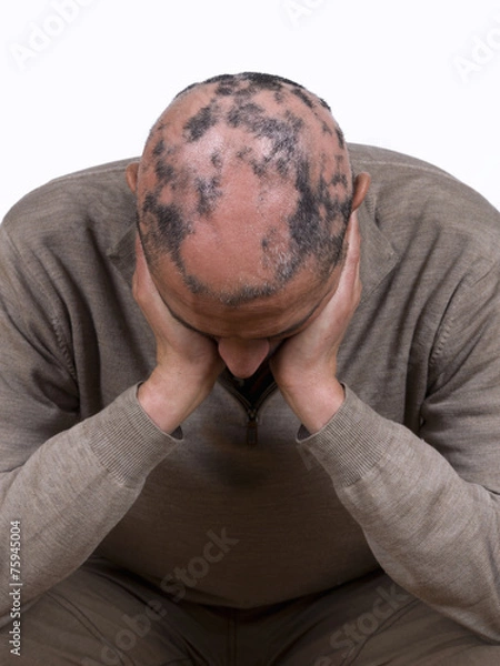 Obraz Alopecia