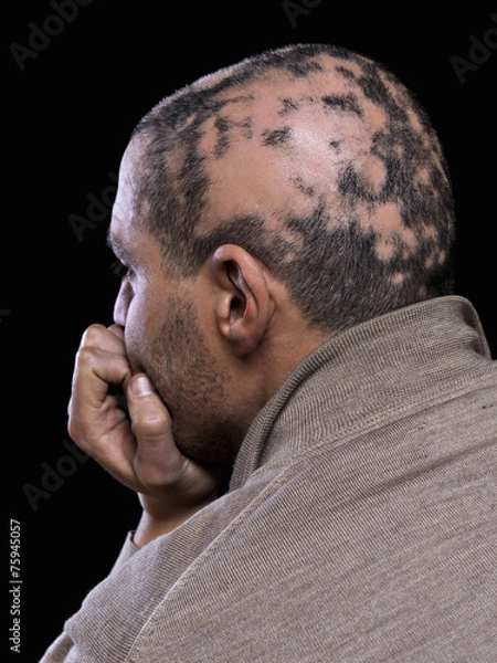 Obraz Alopecia