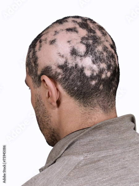 Obraz Alopecia