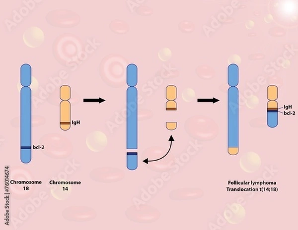 Obraz Follicular lymphoma