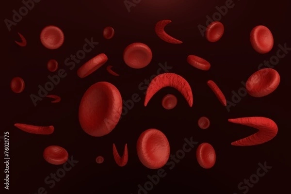 Obraz Sickle and normal red blood cells