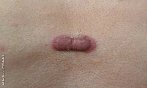 Fototapeta Keloid scars are large, raised scars.