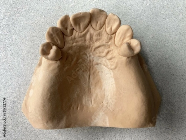 Fototapeta maxillary edentulism: Kennedy class I