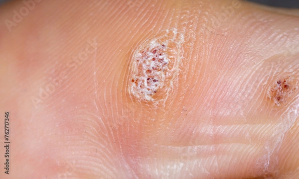 Fototapeta Plantar wart close up on the bottom of a big toe caused by the human papillomavirus, or HPV