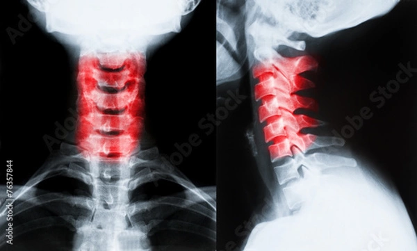 Fototapeta X-ray image of neck