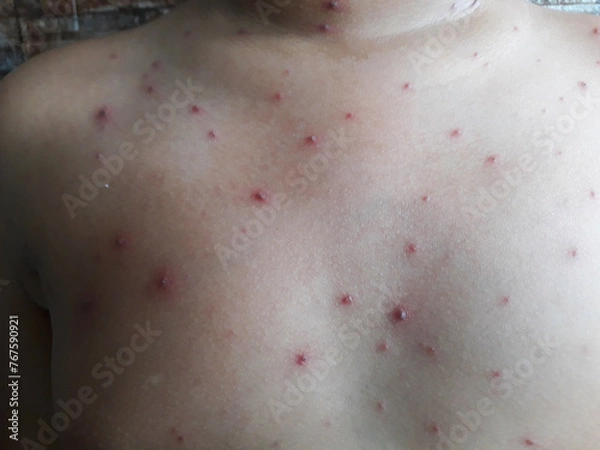 Obraz portrait of elementary age boy itching due to chickenpox. Wellness home care treatment chickenpox because varicella zoster virus