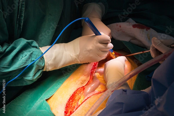 Obraz explore laparotomy