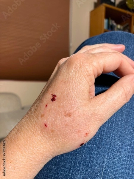 Fototapeta Close up of older woman's hand shows swelling and beginning of infection after cat bite