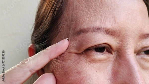 Fototapeta close up of the flabbiness and wrinkle beside the eyelid, Flabby skin and loose, dark spots and blemish, eyelid and ptosis on the face, health care and beauty concept.