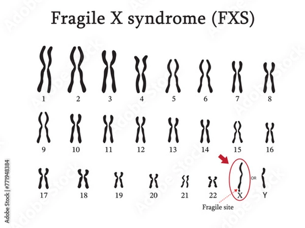 Fototapeta The Karyotype of Fragile X syndrome (FXS) is a genetic disorder of fragile on chromosome x caused by malfunction of gene FMR-1.  