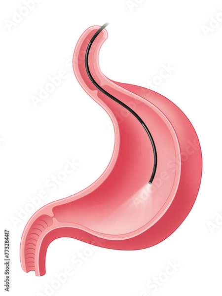 Fototapeta 胃カメラ検査