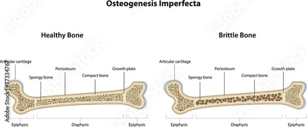 Fototapeta Osteogenesis Imperfecta