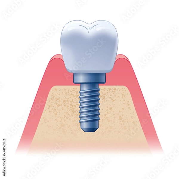 Obraz インプラント断面図