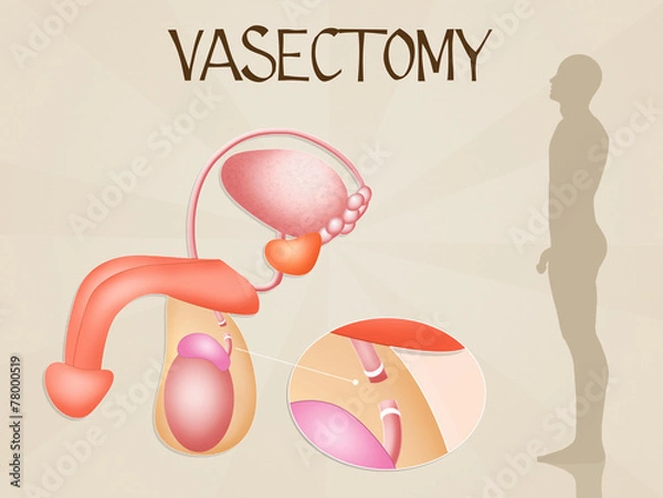 Obraz Vasectomy procedure