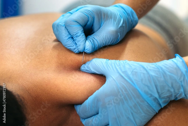 Obraz Physiotherapy Clinic: Dry Needling