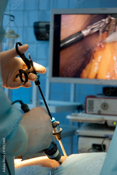 Obraz gallbladder removal