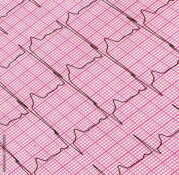 Obraz A fragment of a cardiogram. Cardiological examination
