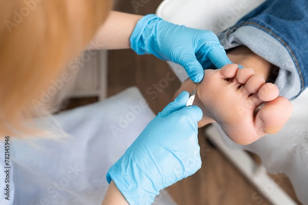 Obraz A podiatrist using clippers removes a callus from a womans foot at the medical center.
