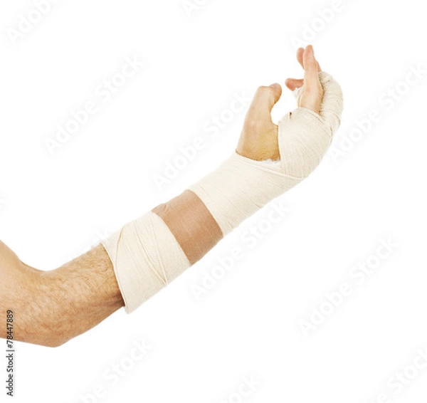 Obraz Broken arm bone in cast. Isolated on white background