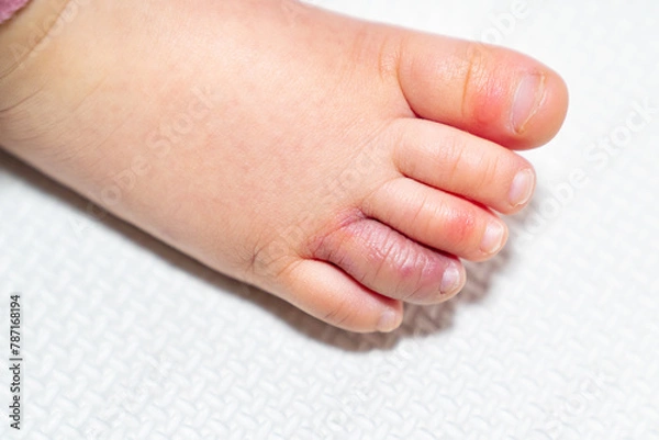 Obraz しもやけになった幼児の足の写真。