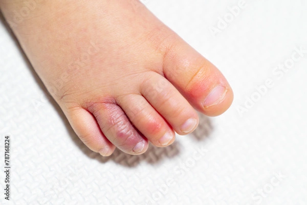 Obraz しもやけになった幼児の足の写真。