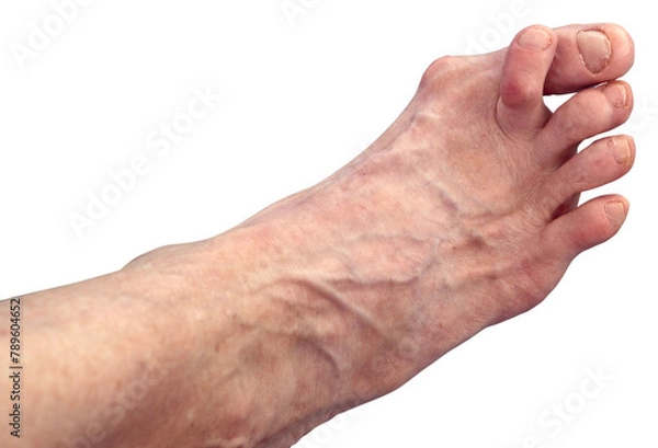 Obraz Isolated woman's hammer toe and bunion.