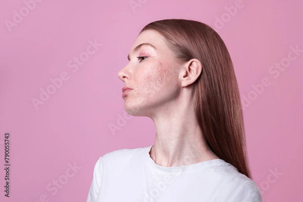 Obraz beautiful red-haired young woman with sensitive rosacea redness acne problem skin, teenage girl profile portrait close up isolated on pink background