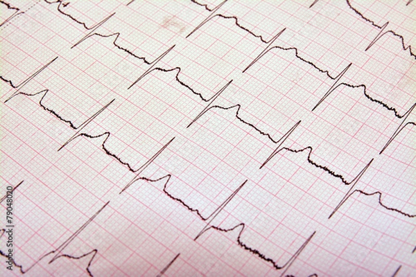 Fototapeta ekg