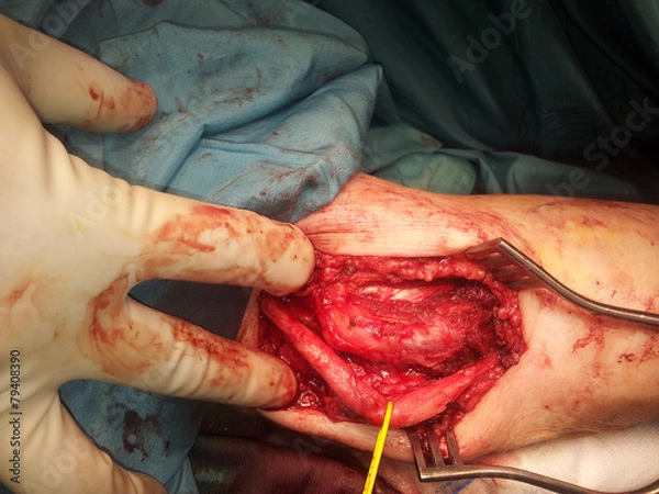 Fototapeta ulnar nerve surgery