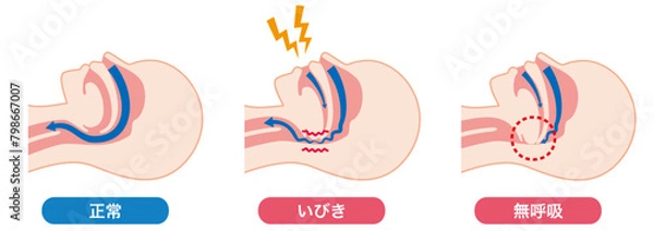 Obraz いびきと睡眠時無呼吸症候群