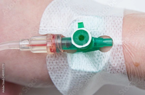 Obraz Kaniula w dłoni