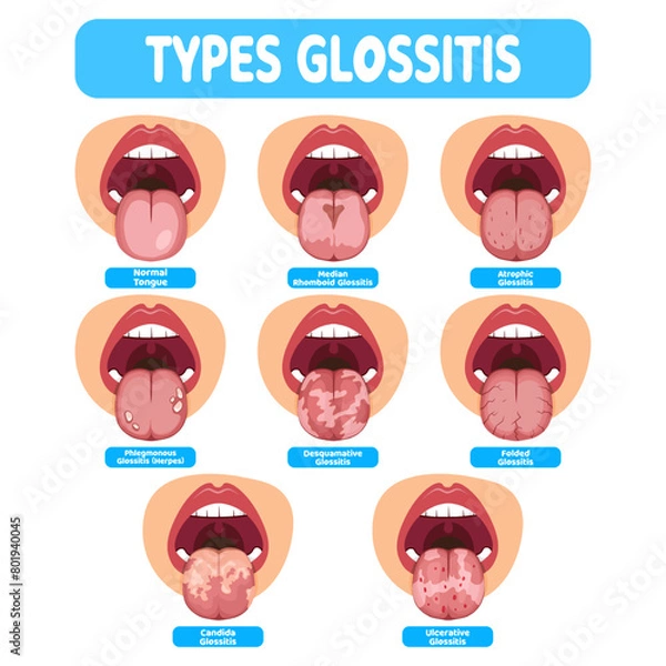 Fototapeta Types Glossitis vector illustration