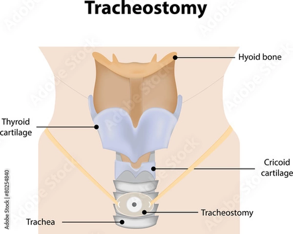 Obraz Tracheostomy Labeled Diagram
