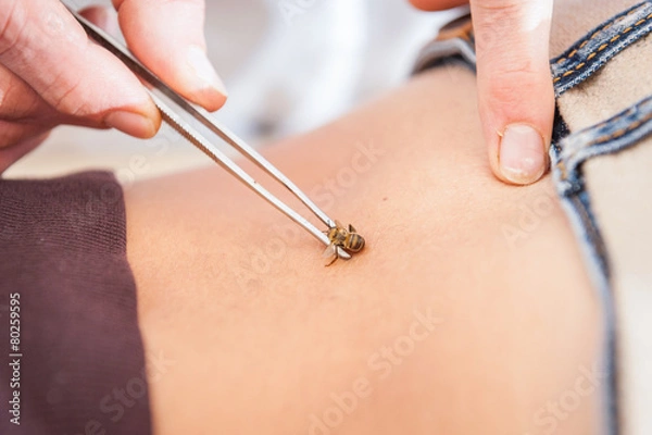 Obraz Apitherapy treatment