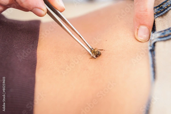 Obraz Apitherapy treatment