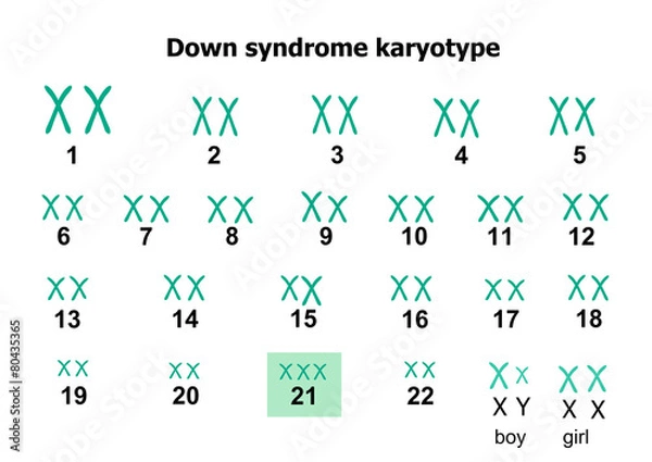 Obraz Down syndrome karyotype