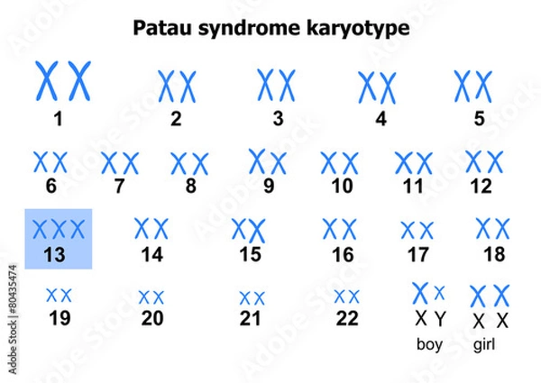 Obraz Patau syndrome