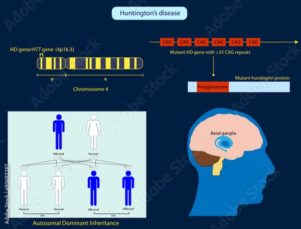 Obraz Huntington's Disease