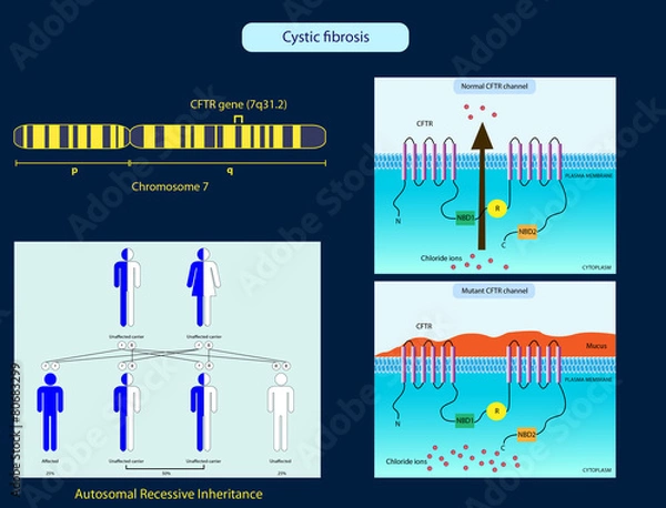 Obraz Cystic fibrosis