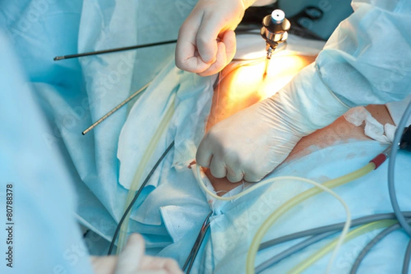 Obraz gallbladder removal