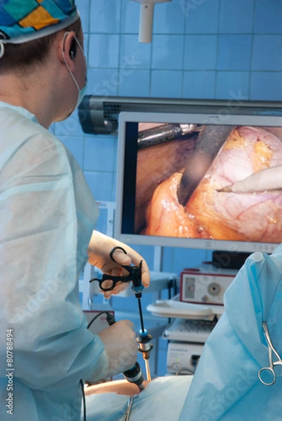 Obraz gallbladder removal