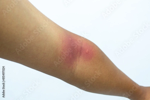 Fototapeta Insect bite on human skin. Swollen mosquito bite. man hand skin turned and scratching bitten