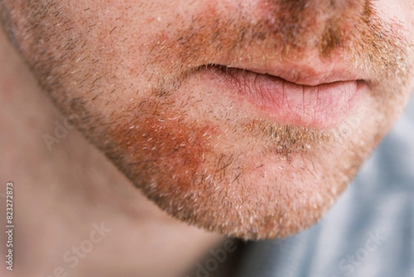 Fototapeta A close-up of a man's face with visible stubble and redness caused by seborrheic dermatitis, showing skin irritation and flaky patches.