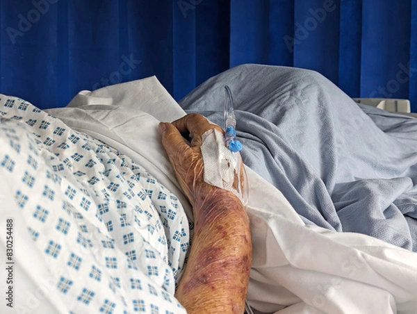 Fototapeta Cropped view of an elderly lady lying in a hospital bed with a cannula in a bruised arm