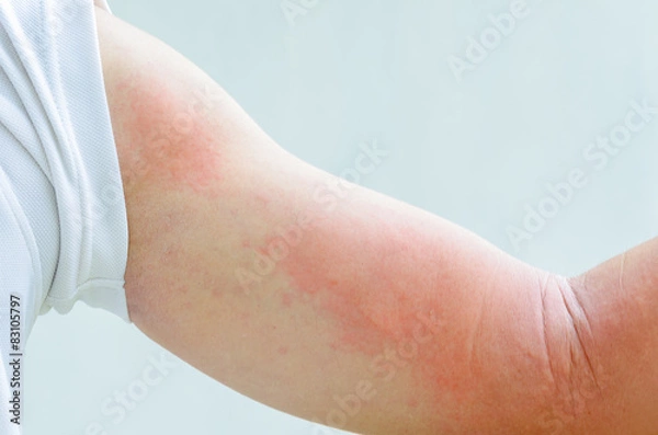 Fototapeta urticaria