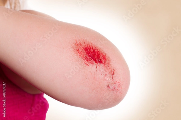 Fototapeta Wunde am Ellenbogen